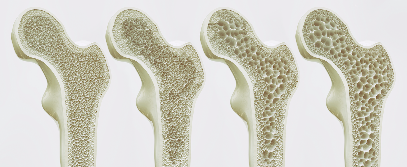Under-rated and under-diagnosed: 7 surprising facts about osteoporosis